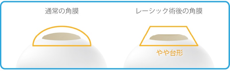 レーシック術後の角膜はやや台形